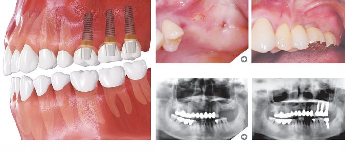 Kelių dantų atkūrimas - ILIUSTRACIJA
